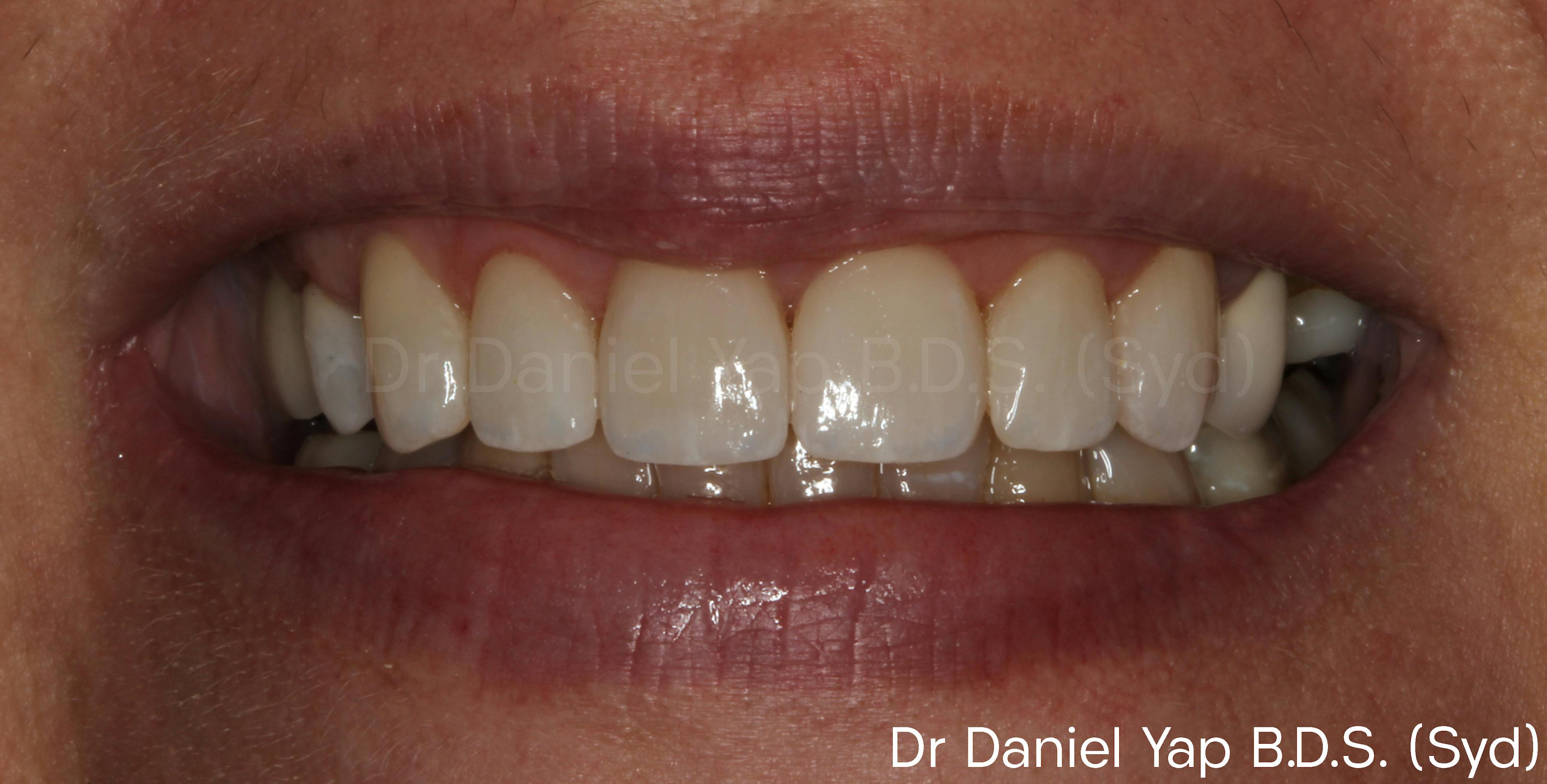 Smile rejuvenation with veneers and crowns after photo