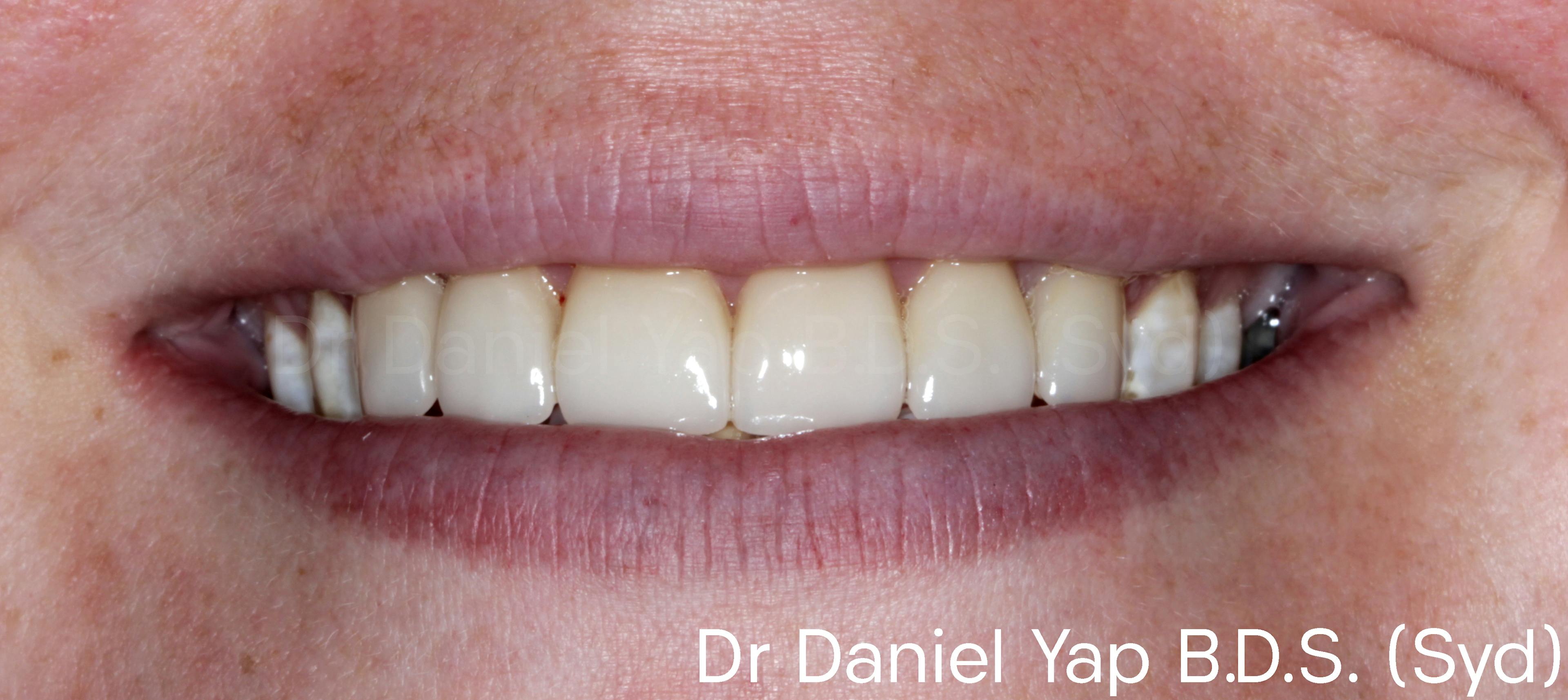 Veneers for enhanced aesthetics and confidence after photo