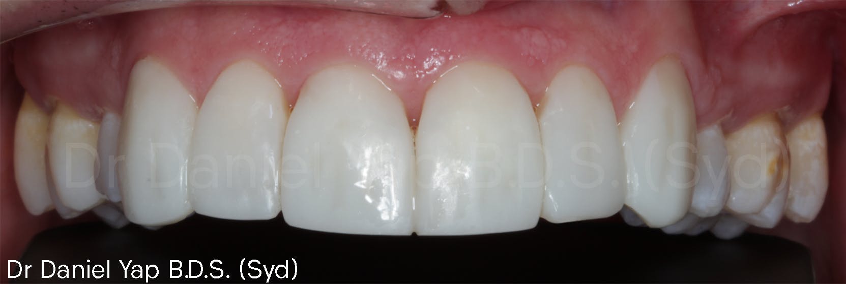 Treatment for a straighter smile after photo