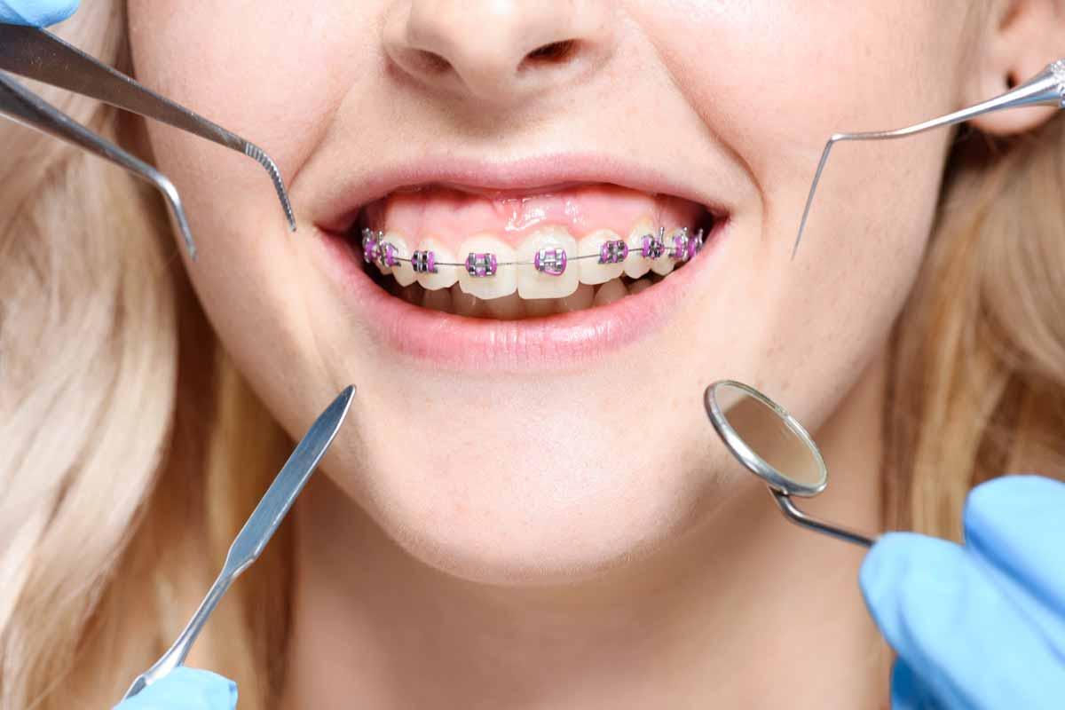 How do braces work and how to care for them? preview image