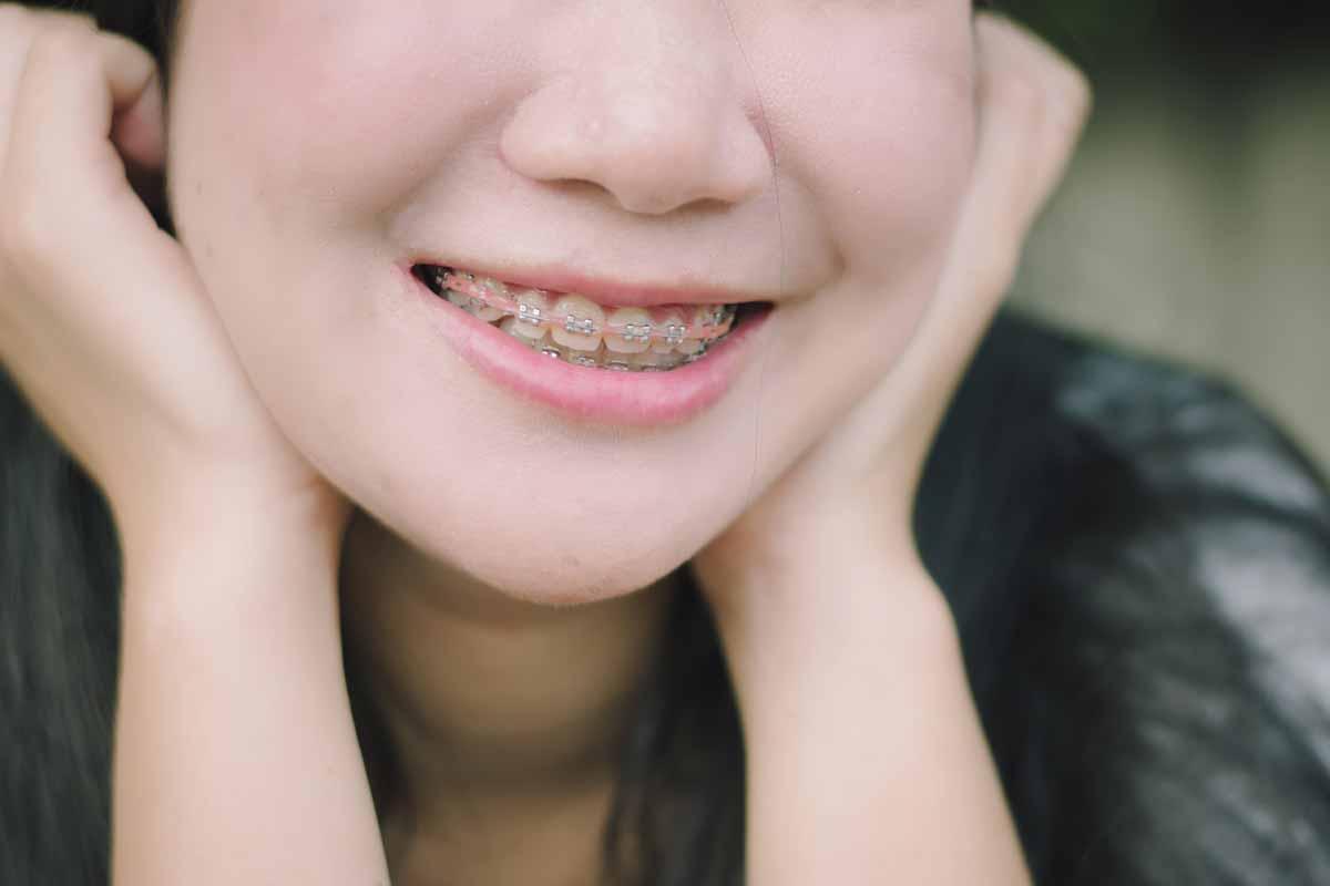5 things to be aware about braces preview image