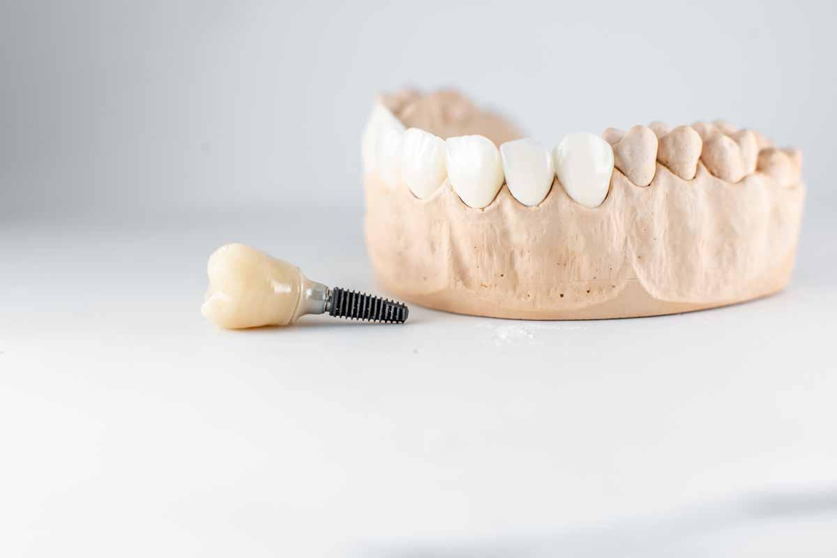 What are the reasons for dental implants failure? preview image