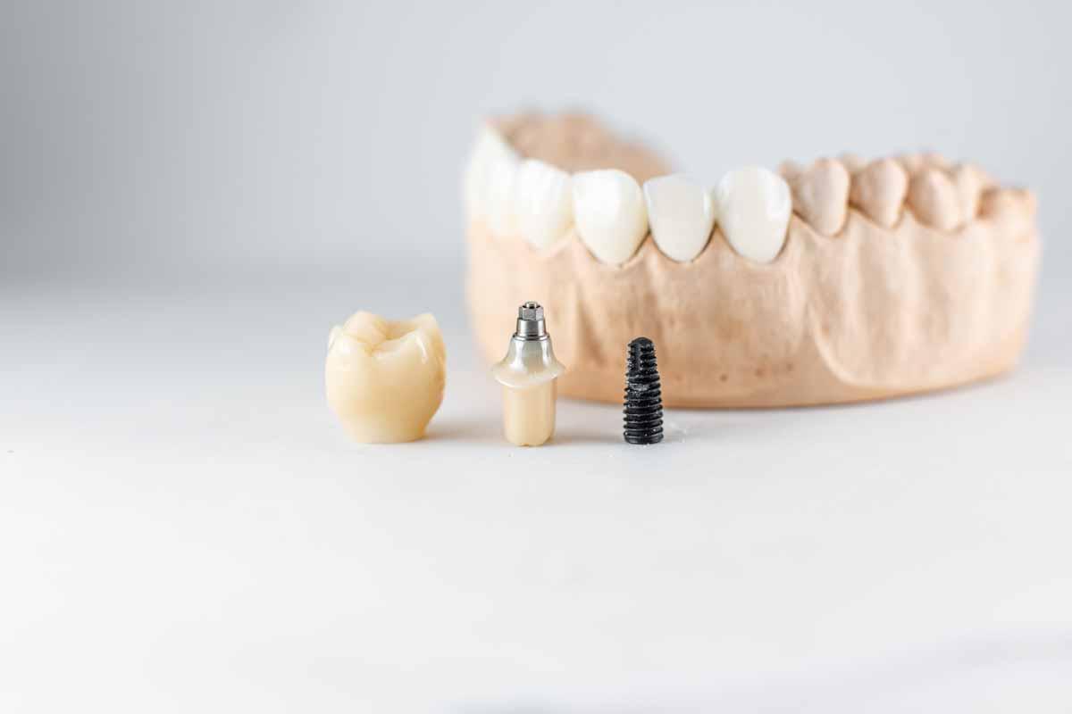 Understanding dental implants preview image
