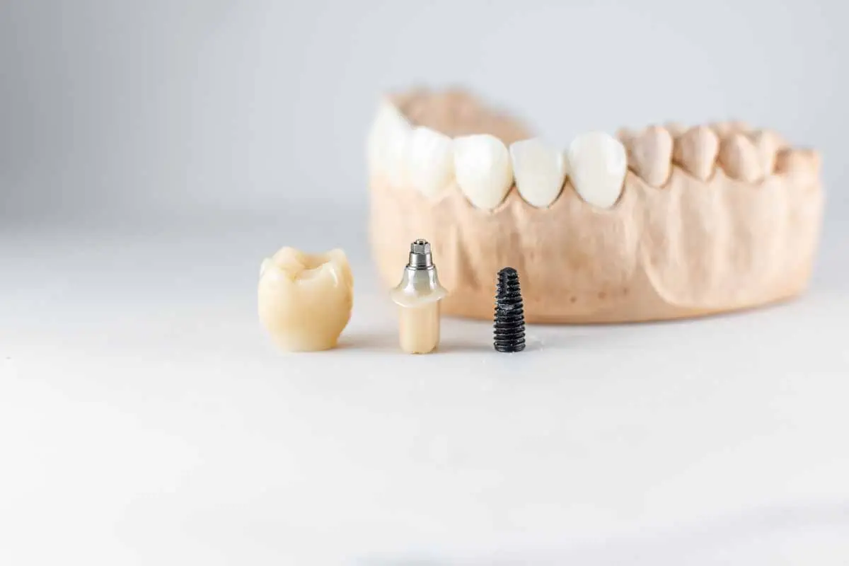 What to Expect After a Dental Implant