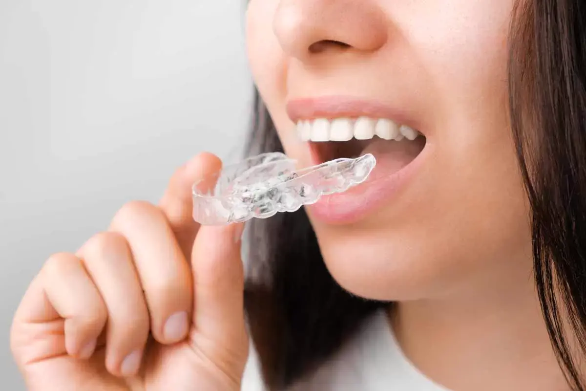 Planning Invisalign? What Smart Patients Ask First